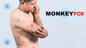Ce trebuie să știi despre variola maimuței